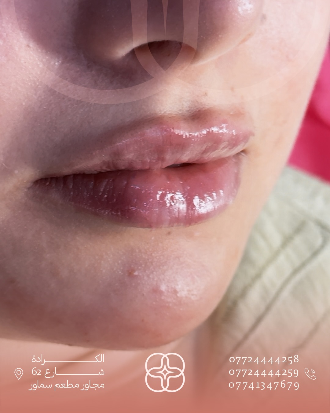 جلسة فيلر شفاه